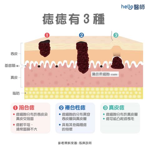 陰莖長痣|蘋果日報